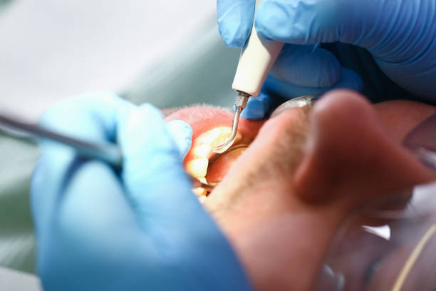 Best Emergency Treatment for Dental Infections or Abscesses in Salem, IL
