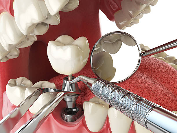Best Emergency Tooth Extraction in Salem, IL